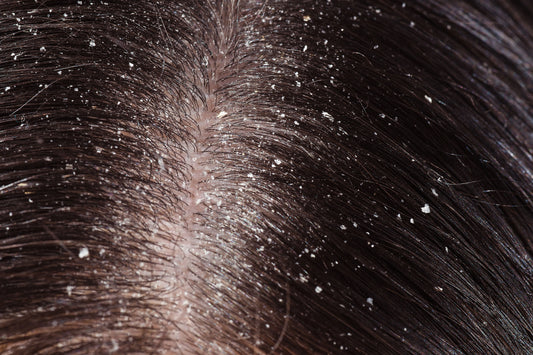 Understand the Cause of Dandruff and Effective Ways to Treat It